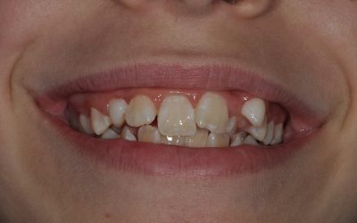 Macchie sui denti?