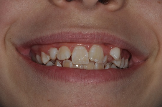 Macchie sui denti?